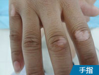 手指白癜风症状图片